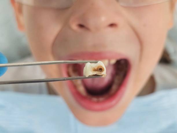 Best Emergency Broken Tooth Repair in West Lafayette, IN